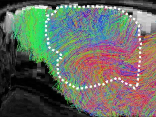 Trasplantan tejido cerebral humano en ratones de laboratorio